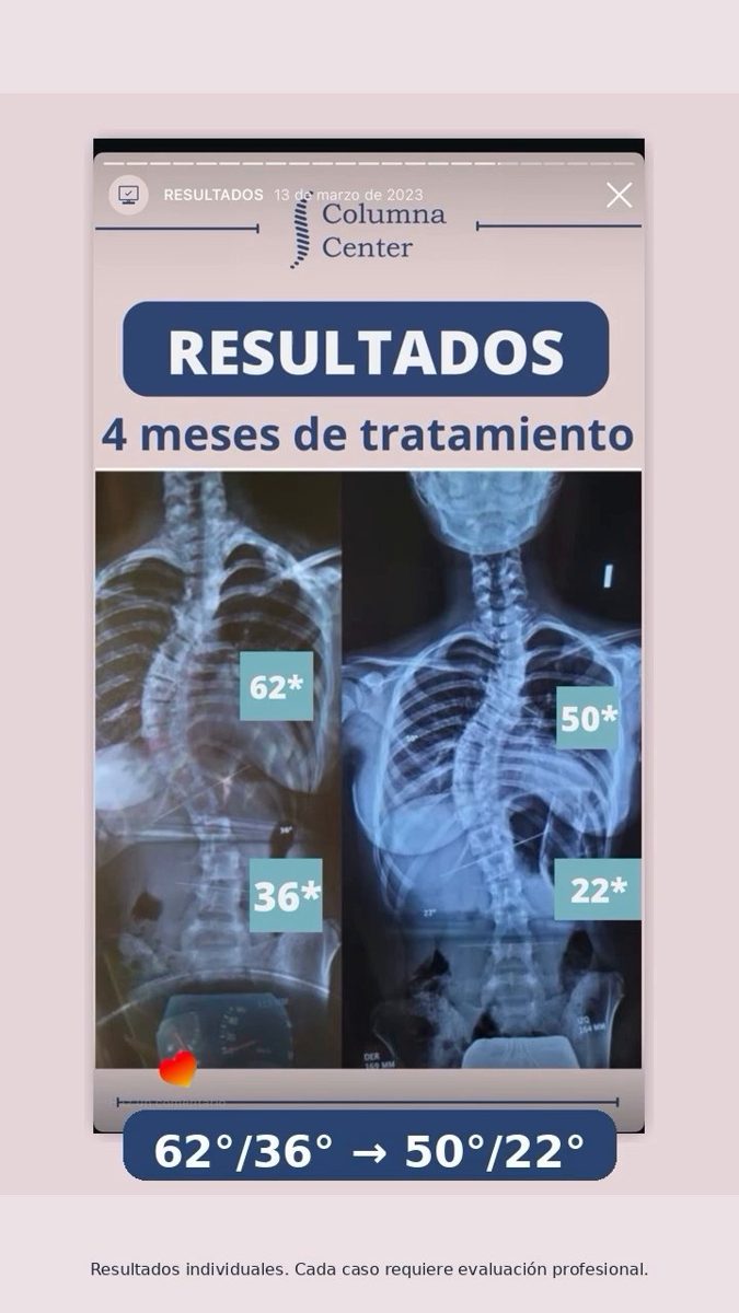 Radiografía antes y después, 4 meses de tratamiento, 62/36 a 50/22 grados
